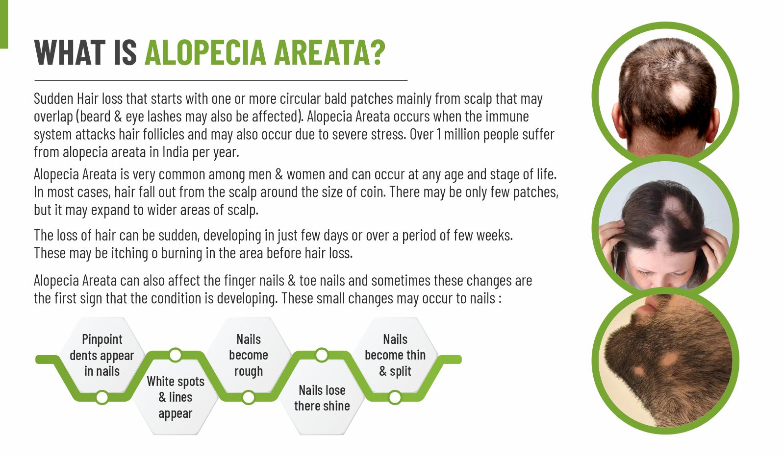 Alopecia Areata Spray - Best Ayurvedic Treatment Medicine
