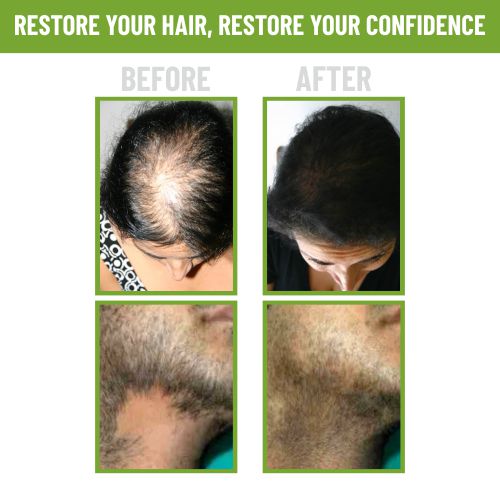 alopecia areata ayurvedic treatment