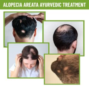 Types Of Alopecia Areata / Penu korukudu and Ayurvedic Treatment