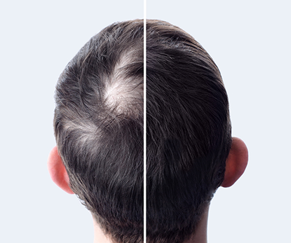 before after
