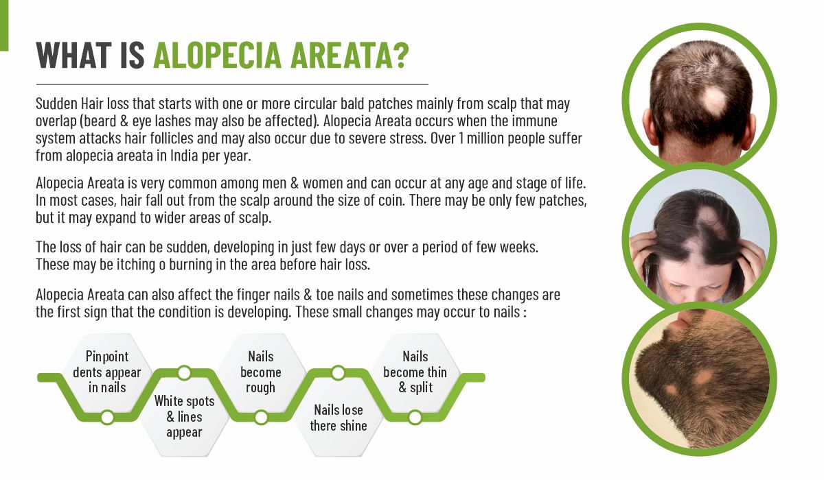 SBH Alopecia Areata spray Medicine