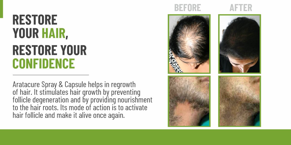 SBH Alopecia Areata spray Medicine