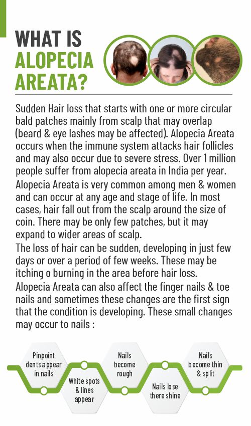 SBH Alopecia Areata spray Medicine